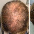 Scalp Treatments for Hair Growth: Boost Your Hair Regrowth Journey