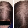 Understanding Hereditary Hair Loss and Ways to Enhance Your Hair