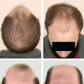 How to Diagnose and Treat Male Pattern Baldness