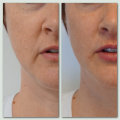 Enhance Your Lips with Microcannula Injections