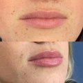 All You Need to Know About Lip Flip (Botox)