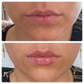 Can lip fillers cause long term effects?