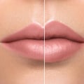 Lip Fillers Without Needles (Hyaluron Pen): A Comprehensive Guide