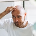 Lifestyle Factors and Male Pattern Baldness: How Your Habits and Choices Affect Your Hair