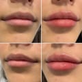 Is it normal for lip fillers to disappear?