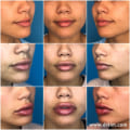 Is 2 ml of lip fillers a lot?