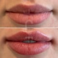 Will 1ml of lip fillers make a difference?