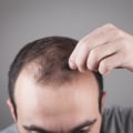 Thyroid Disorders and Hair Loss: Understanding the Connection