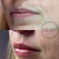 Is 1 ml of lip fillers enough?