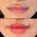 Exploring Different Types of Fillers for Lip Augmentation