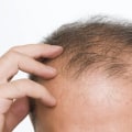 All You Need to Know About Minoxidil