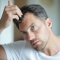 Hormonal Changes and Male Pattern Baldness: Understanding the Causes and Risks