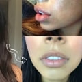 Is getting lip fillers worth it?