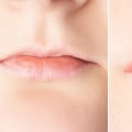 What happens to lip fillers as you age?