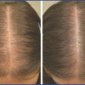 Understanding Medical Treatments for Female Hair Loss