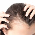 Hormonal Imbalances and Hair Loss: Understanding the Link