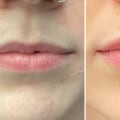 How long do lip fillers last first time?