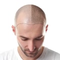 Scalp Camouflage Techniques: Enhancing Your Look