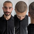 All You Need to Know About Hair Transplants