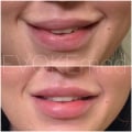 What if i am not happy with lip fillers?