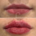 Will your lips go back to normal after lip fillers?