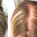 Understanding Pregnancy and Postpartum Hair Loss