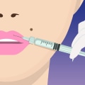 All You Need to Know About Syringe Injections for Lip Fillers