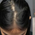 Alopecia: Understanding Hair Loss and Its Causes