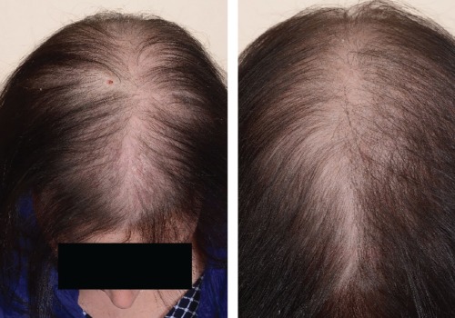 Understanding Hereditary Hair Loss and Ways to Enhance Your Hair