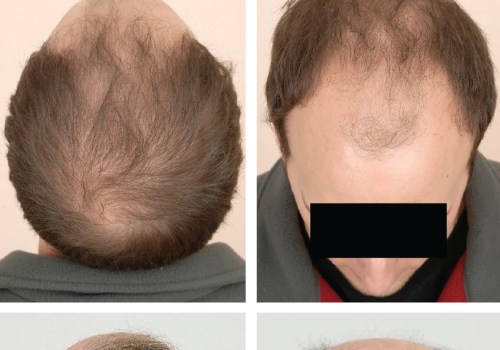 How to Diagnose and Treat Male Pattern Baldness