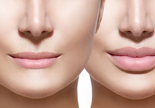 How to Enhance Your Lips with Non-Surgical Options