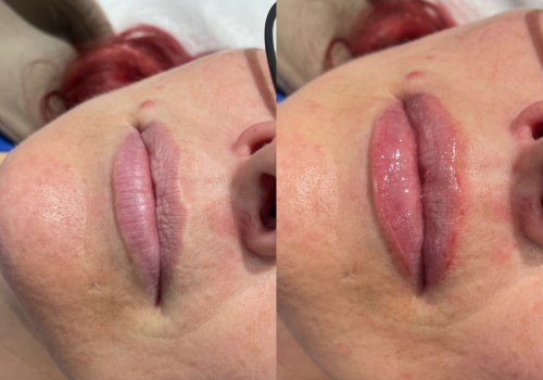 Do lip fillers ruin your lips over time?