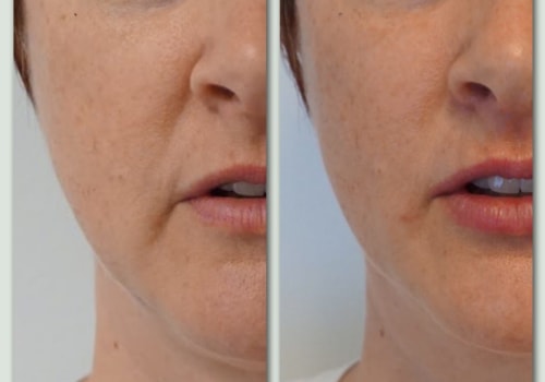 Enhance Your Lips with Microcannula Injections