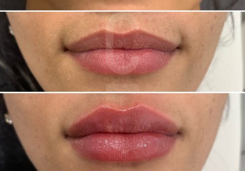 Do lip fillers last longer the second time?