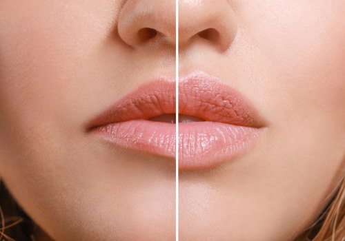 Understanding Dermal Filler Dissolving for Non-Surgical Lip Enhancement