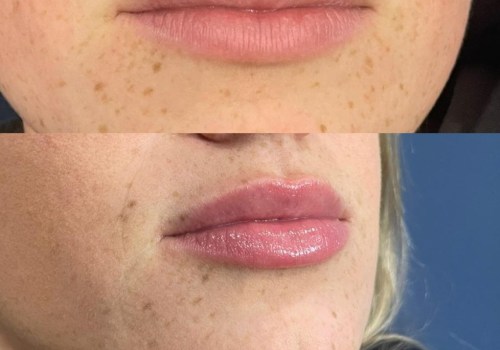 All You Need to Know About Lip Flip (Botox)