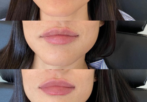 Is 2 syringes of lip fillers a lot?