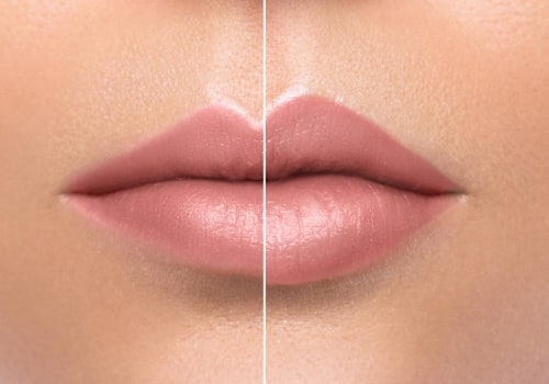 Lip Fillers Without Needles (Hyaluron Pen): A Comprehensive Guide