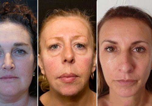 What happens after years of lip fillers?