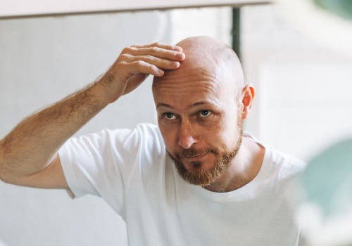 Lifestyle Factors and Male Pattern Baldness: How Your Habits and Choices Affect Your Hair