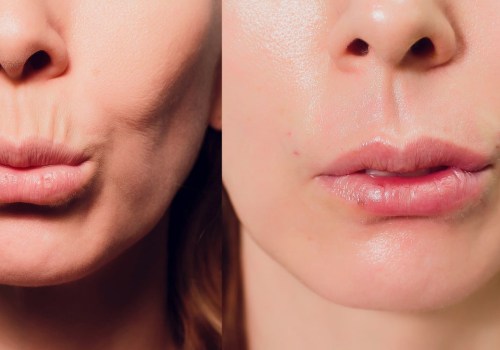 Discover the Benefits of Thread Lift (PDO Threads) for Non-Surgical Lip Enhancement