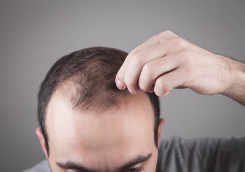 Thyroid Disorders and Hair Loss: Understanding the Connection