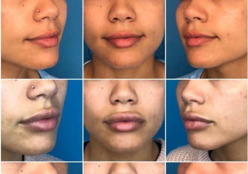 How many ml of lip fillers should i get?