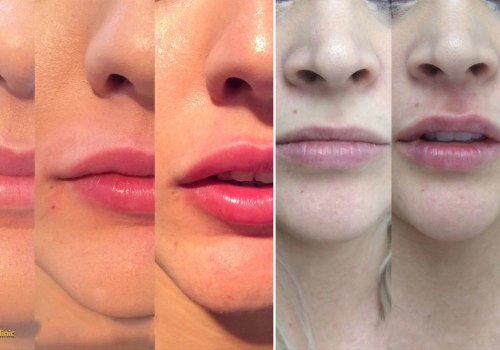 The Essential Qualifications of a Provider for Non-Surgical Lip Enhancement