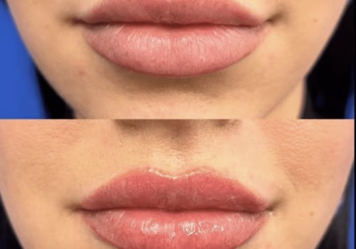 The Power of Radiofrequency Lip Plumping