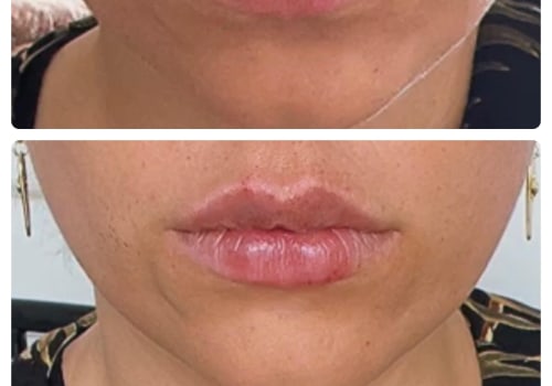 What are the long term effects of lip fillers?