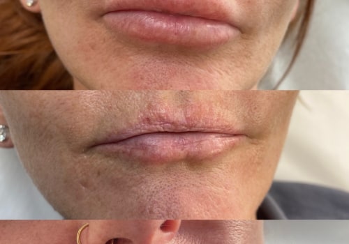 Do your lips shrink after lip fillers?