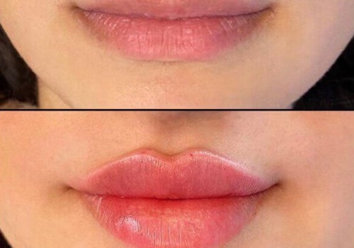 Exploring Different Types of Fillers for Lip Augmentation