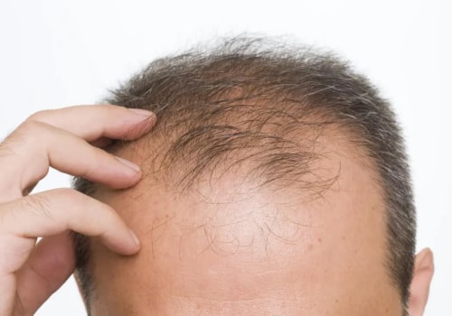 All You Need to Know About Minoxidil