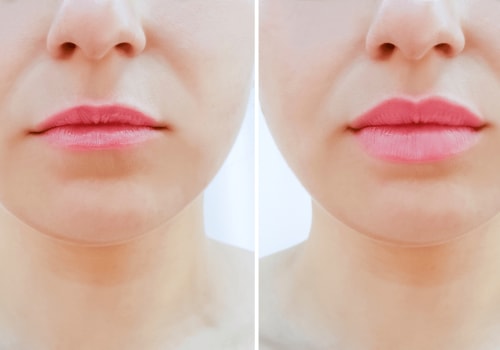 Reversible Treatments for Fuller Lips